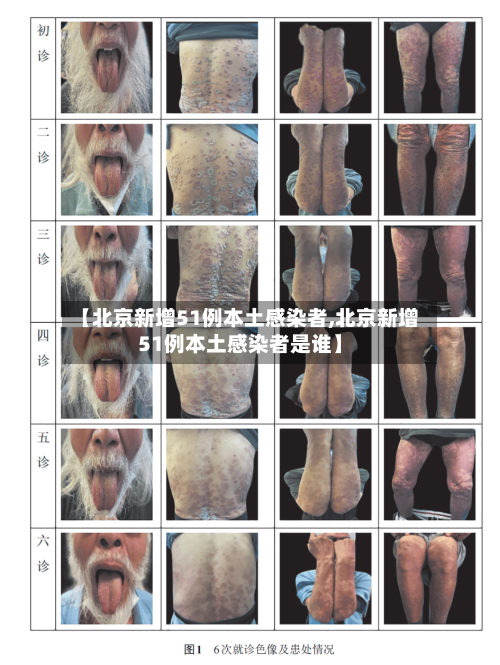 【北京新增51例本土感染者,北京新增51例本土感染者是谁】